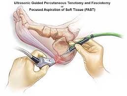 plantar fasc 10 jet